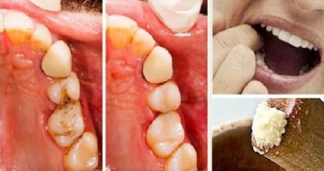 Vylečte zubní kaz a zastavte bolest zubů bez návštěvy zubaře pomocí tohoto úžasného přípravku!