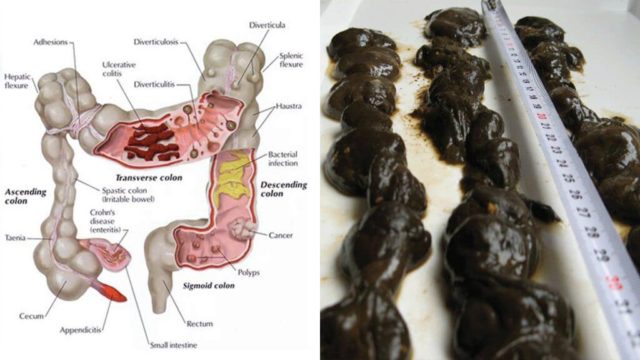 Tato kombinace vyplaví všechny toxiny a dokonale pročistí vaše střeva