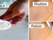 Odstraňte bradavice, vyrážky a znaménka na pokožce s tímto přírodním receptem