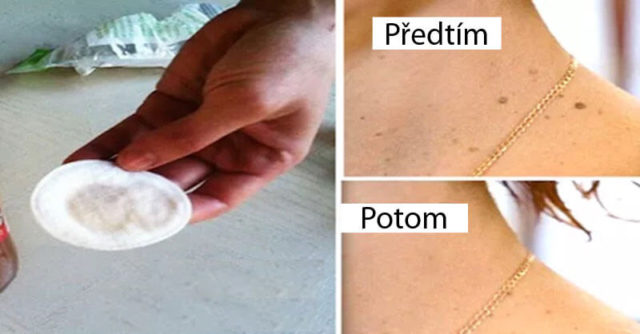 Odstraňte-bradavice,-vyrážky-a-znaménka-na-pokožce-s-tímto-přírodním-receptem